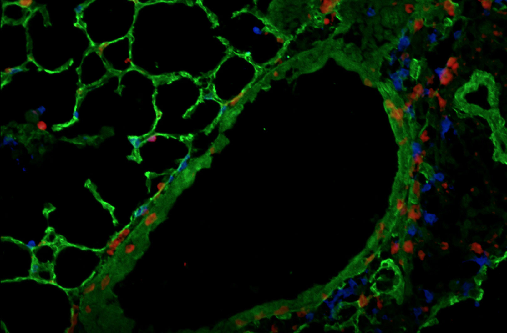 Microscopic view of mouse lung after infection with influenza. Image courtesy of David Topham (microbiology & immunology)